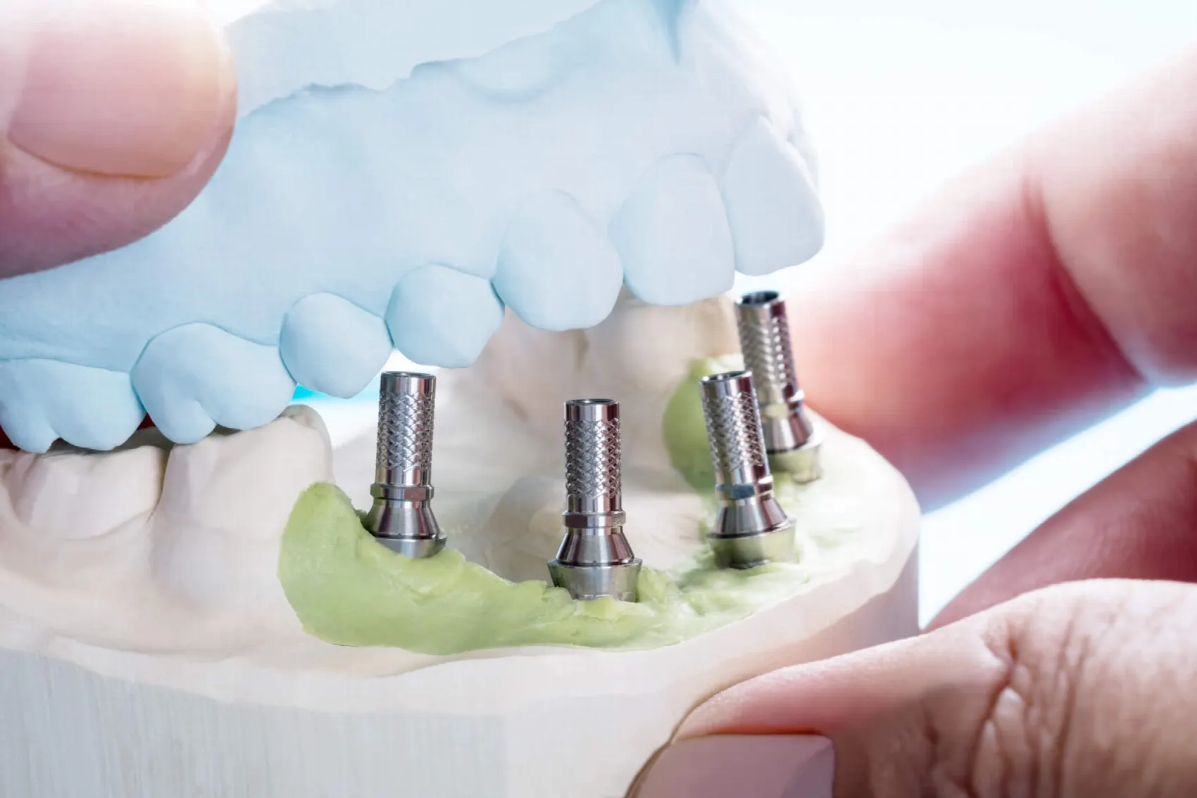 Jaw model with mini implants supporting a denture