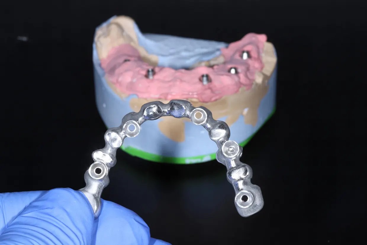 Dental implants in Košice and Chorvátsky Grob near Bratislava – modern implant procedures and permanent replacement of missing teeth