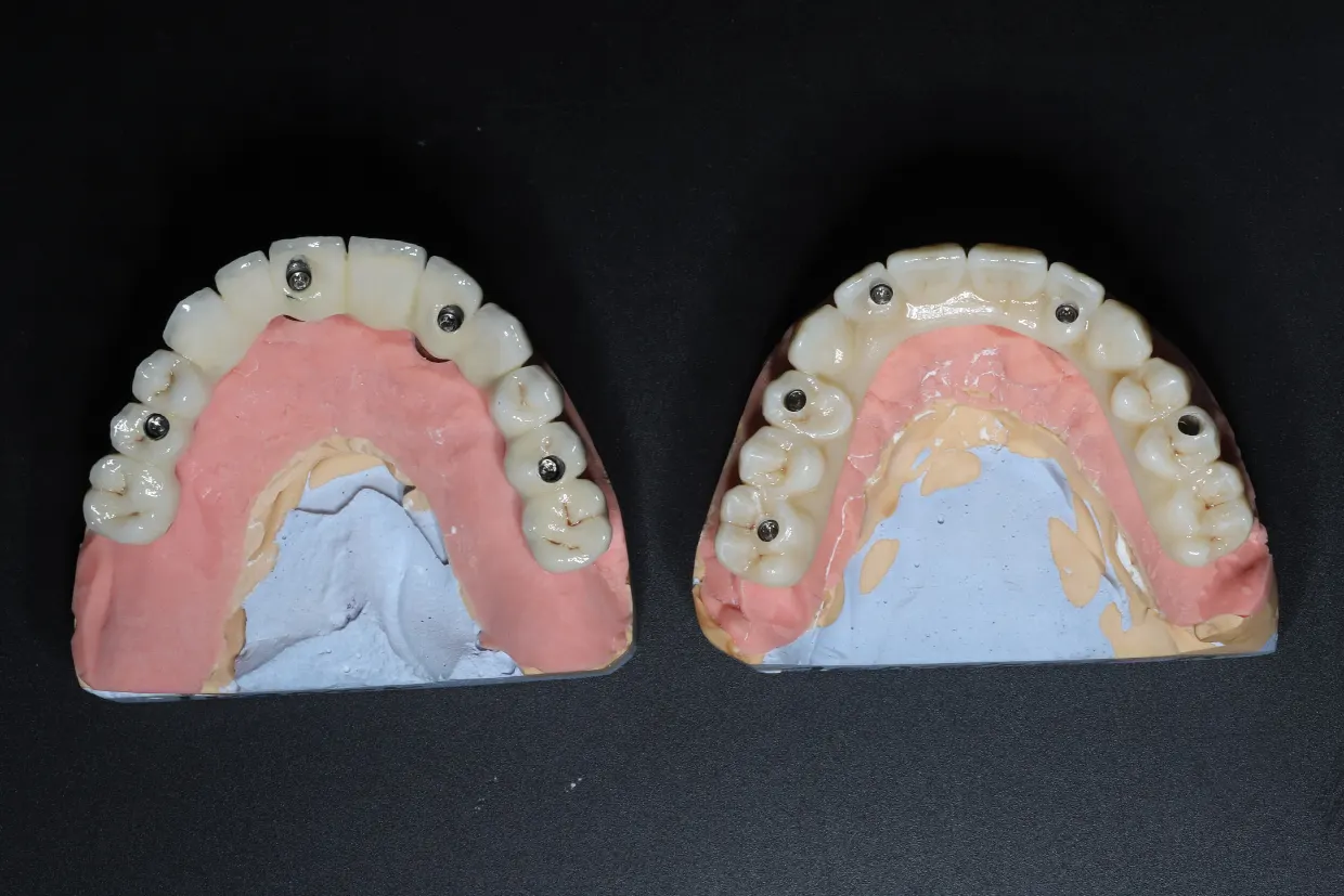 Fixné zubné náhrady na implantátoch all-on-4 a all-on-6 pre ošetrenie „zuby za jeden deň“