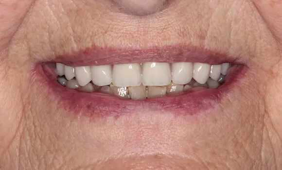 Rekonštrukcia chrupu metódou all-on-6 – výsledok po ošetrení v zubnej klinike HAPPYDENT