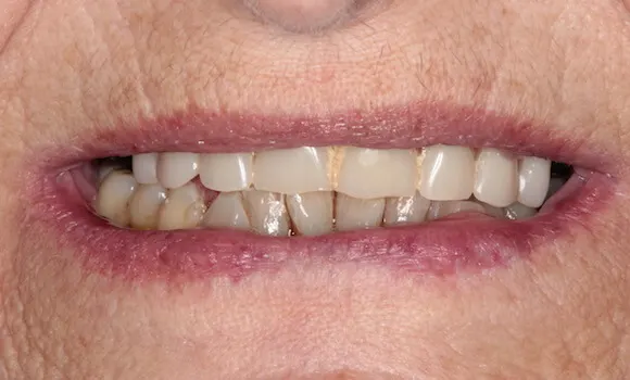 Rekonštrukcia chrupu metódou all-on-6 – stav pred ošetrením v zubnej klinike HAPPYDENT