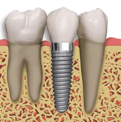 Zubný implantát – skrutka, abutment a korunka pre trvalú náhradu chýbajúceho zuba v zubnej klinike HAPPYDENT v Košiciach a Chorvátskom Grobe pri Bratislave