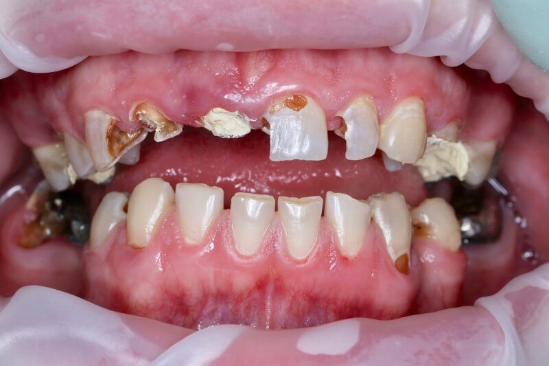 Суцільнокерамічні коронки – до лікування в зубній клініці HAPPYDENT