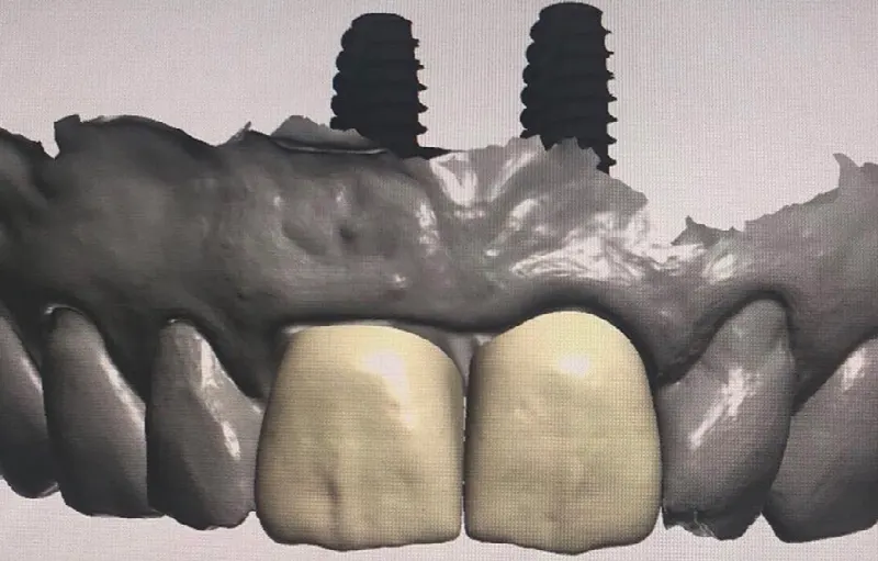 3D snímka implantátov s korunkami v hornej čeľusti – navigovaná chirurgia