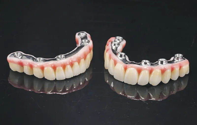 Zubné náhrady s kovovou konštrukciou na implantátoch pre obe čeľuste