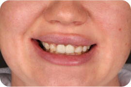 Veneers