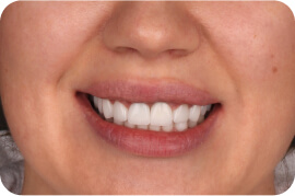 Veneers
