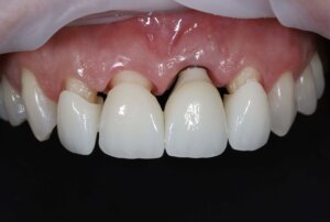 Комплексна реконструкція зубів – до лікування, робота лабораторії HAPPYDENT LAB