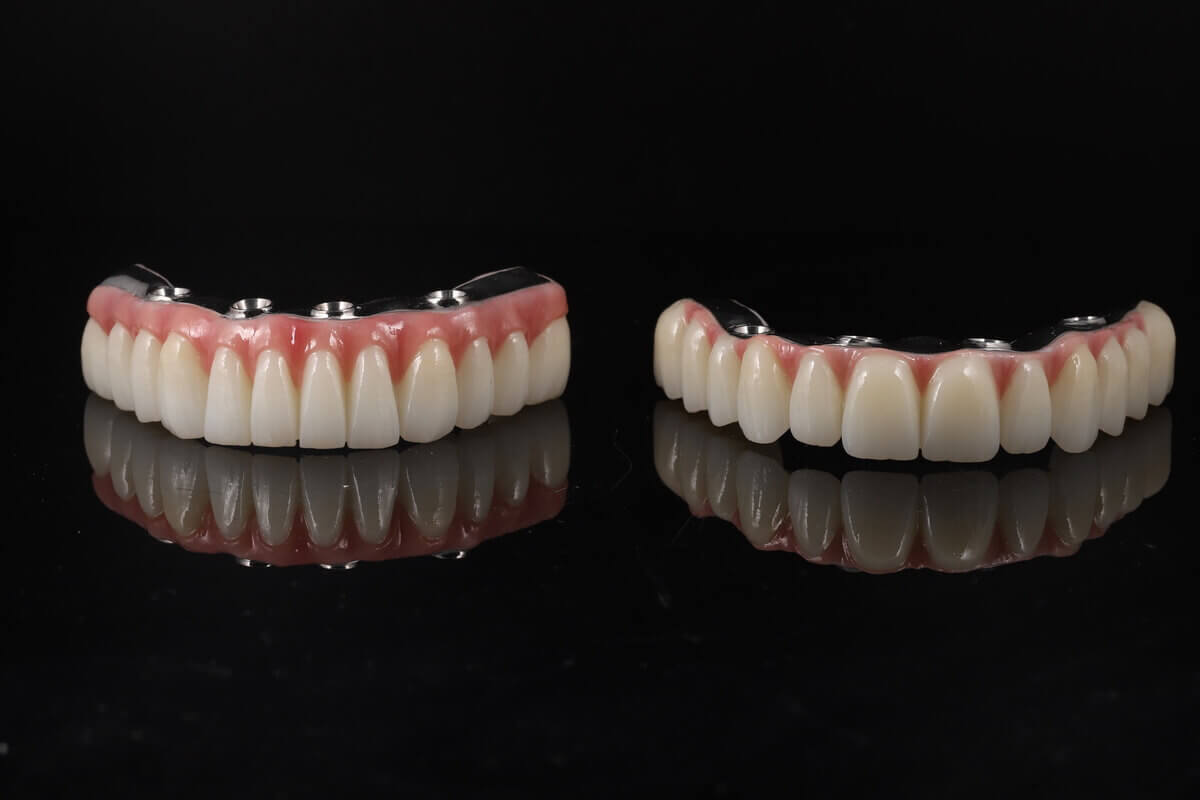 Fixed all-on-4 dentures for the upper and lower jaw