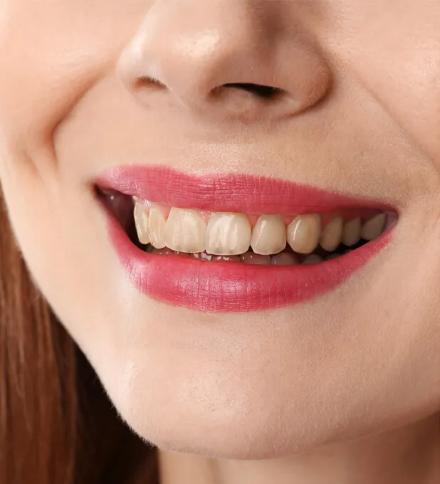 Zuby pred bielením v zubnej ambulancii HAPPYDENT v Košiciach a Chorvátskom Grobe