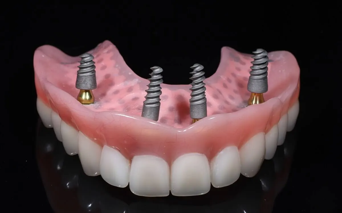 Zubná protéza na implantátoch
