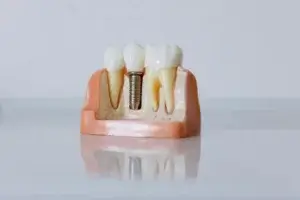 Model zubného implantátu medzi vlastnými zubami