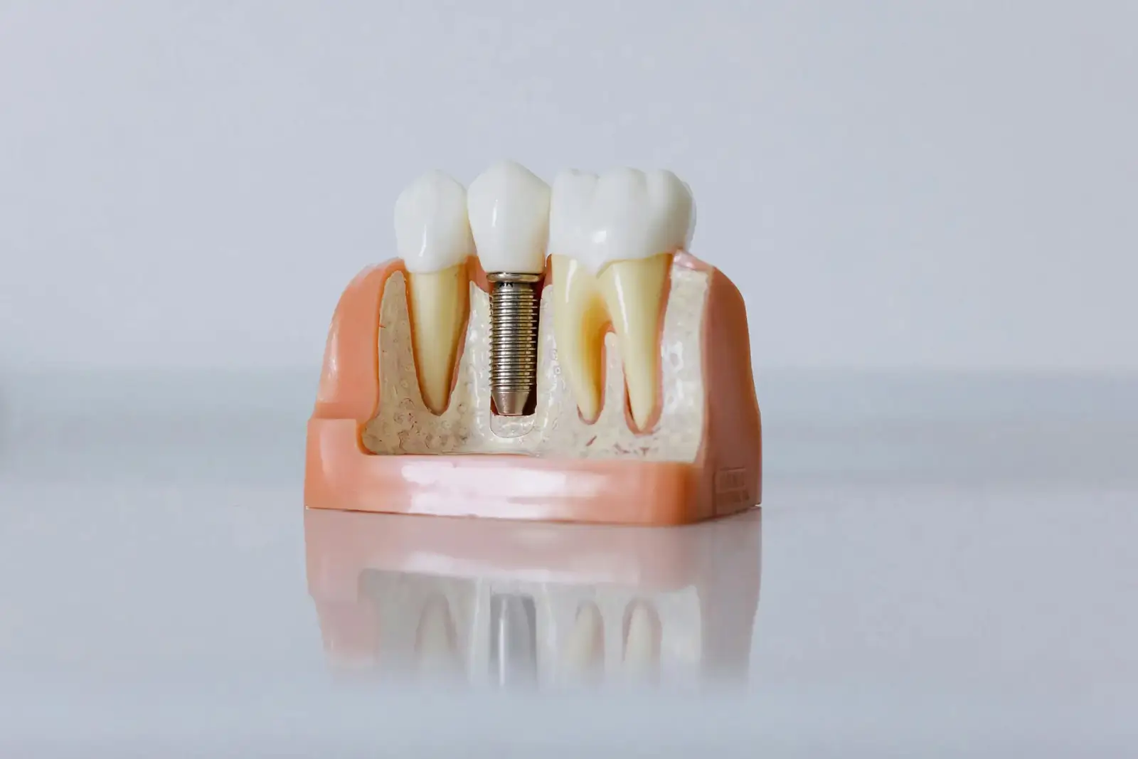 Implantácia zubných implantátov v zubnej klinike HAPPYDENT v Košiciach a Chorvátskom Grobe pri Bratislave