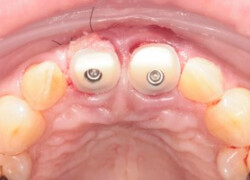 Two implants with healing abutments in the upper jaw, occlusal view