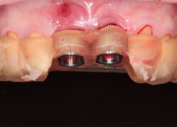 Zirkónový mostík na implantátoch – stav pred ošetrením v zubnej klinike HAPPYDENT