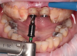 Zavedenie implantátu v prednom úseku hornej čeľuste