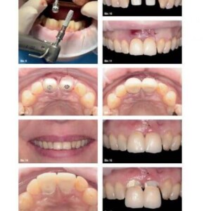 Zirconia bridge on implants – before treatment at the HAPPYDENT dental clinic