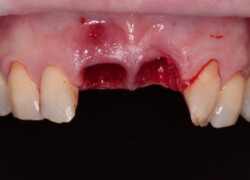 Zirconia bridge on implants – the result after treatment at the HAPPYDENT dental clinic