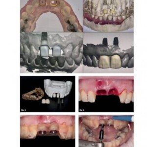 Zirconia bridge on implants – the result after treatment at the HAPPYDENT dental clinic