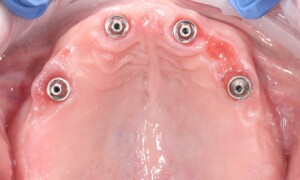 Upper jaw with four implant abutments before the all-on-4 bridge is fitted