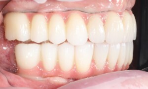 Complete dental reconstruction – side view of the finished teeth