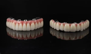 Fixné zubné náhrady na implantátoch all-on-4 pre hornú a dolnú čeľusť