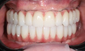 Complete dental reconstruction of both jaws – the final result