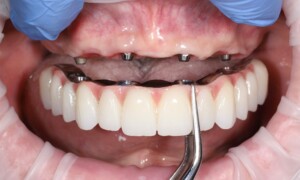 Nasadzovanie fixného mostíka na implantáty v hornej čeľusti
